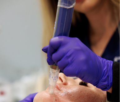 RF Microneedling